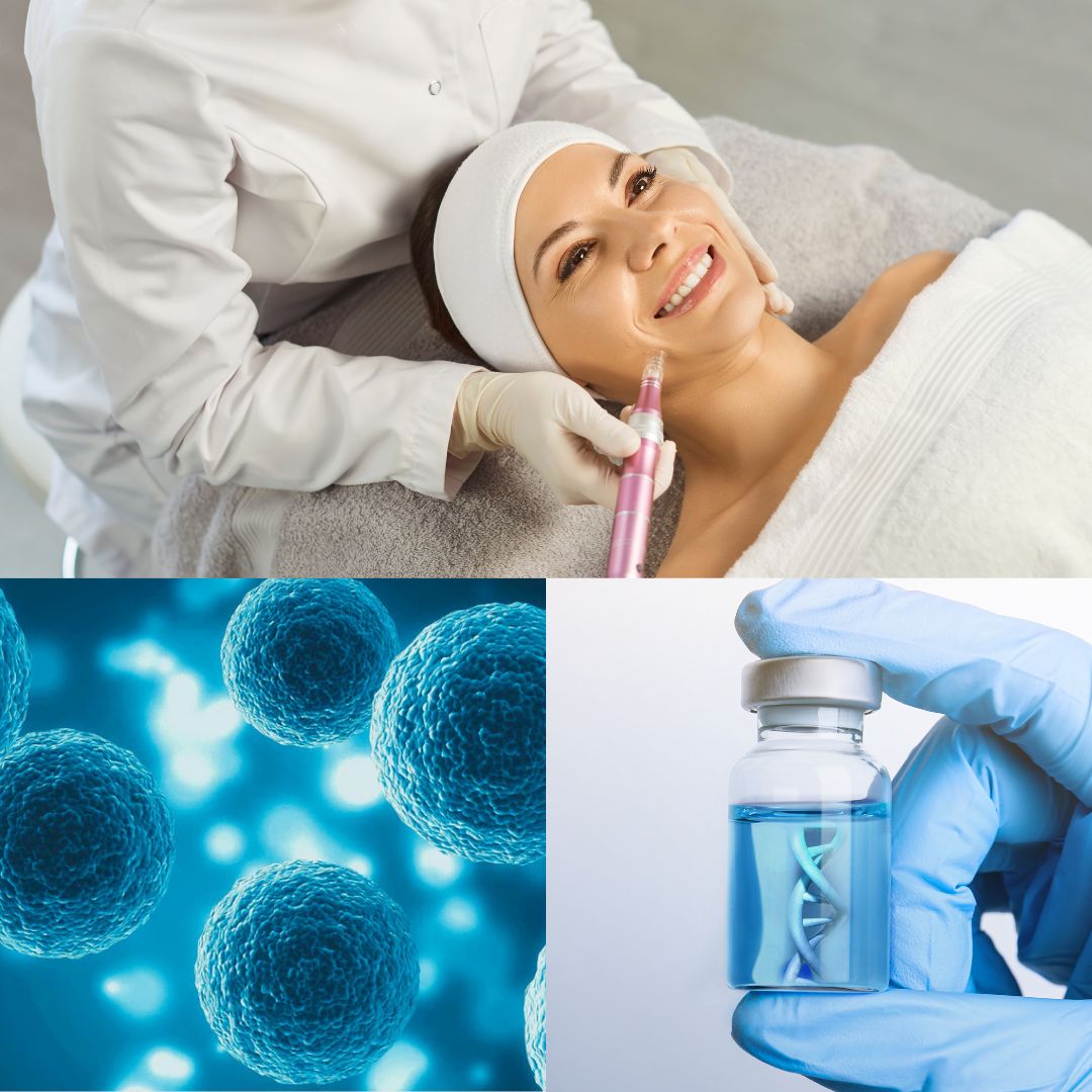 Microneedling cu Exozomi / PDRN Sibiu