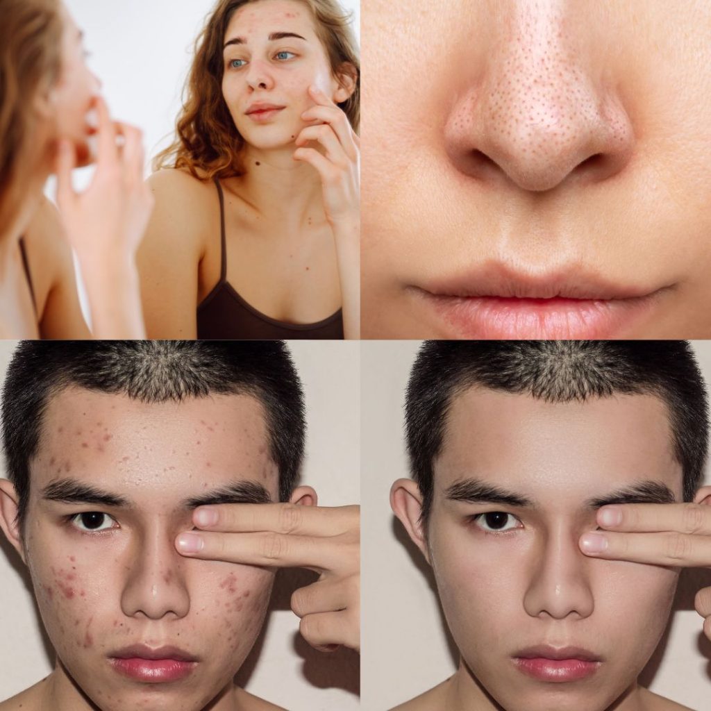 extractii-acnee-curatare